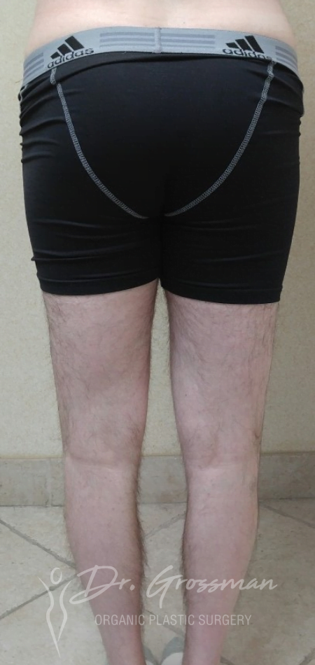 Before Calf Augmentation With fat service