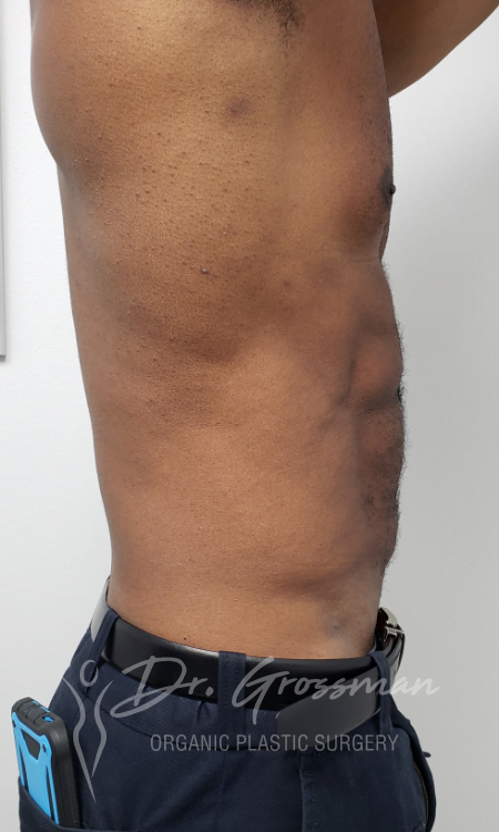 After Abdominal Lipoetching Treatment
