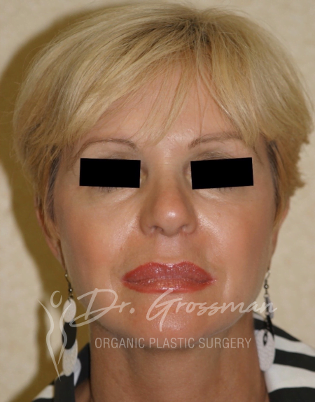After Face Rejuvenation | New York City Plastic Surgery PC