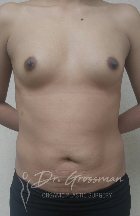 Before Breast Augmentation With Fat | New York City Plastic Surgery PC