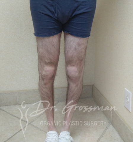 Before Calf Augmentation With fat service
