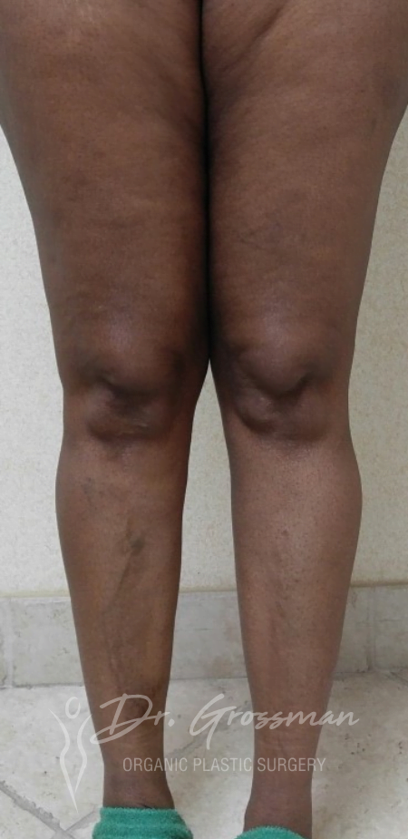 Bowed Leg Correction | New York City Plastic Surgery PC