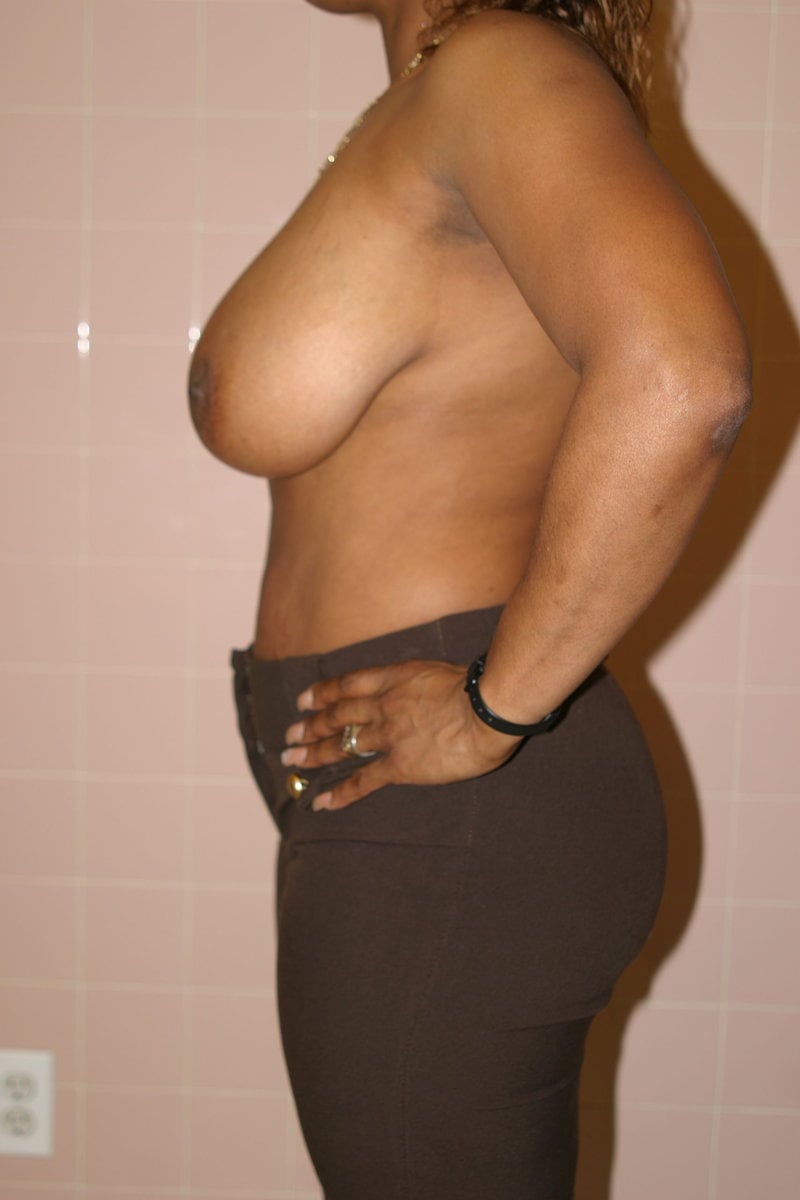 breast reduction 003 scaled