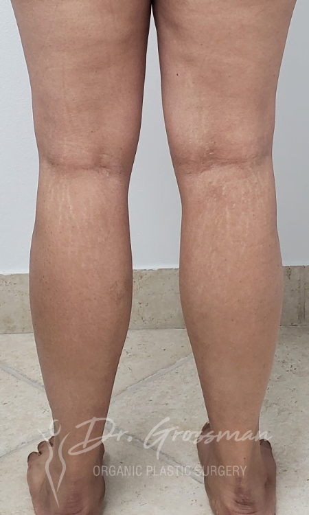 Calf Augmentation with Fat | New York City Plastic Surgery PC