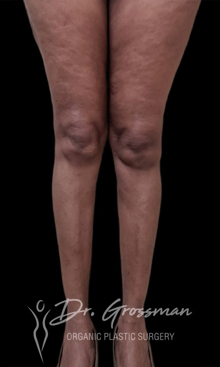 calf augmentation with fat b