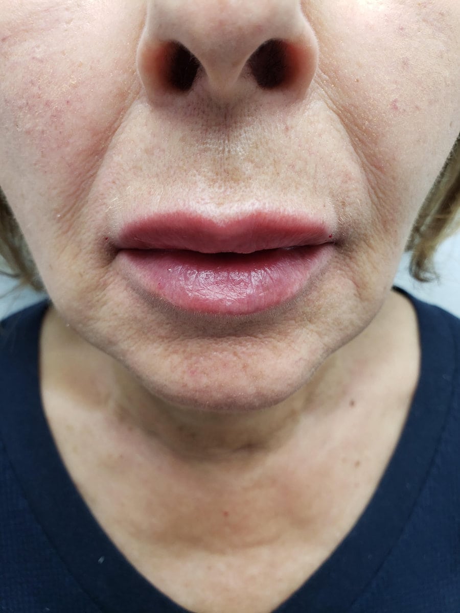 Lip Augmentation in New York City Plastic Surgery