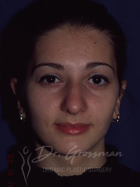 drgrossman otoplasty bb