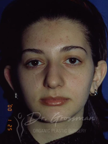 drgrossman otoplasty bc