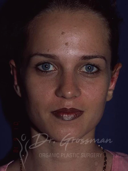 drgrossman otoplasty bf