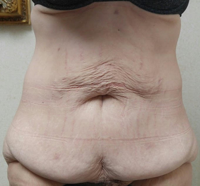 Dr.grossman Tummy