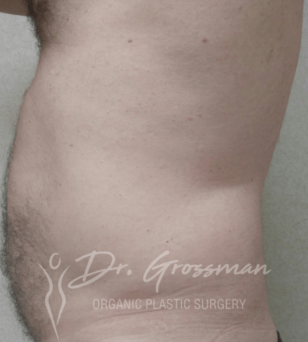 Flank Liposuction Male in New York City Plastic Surgery PC