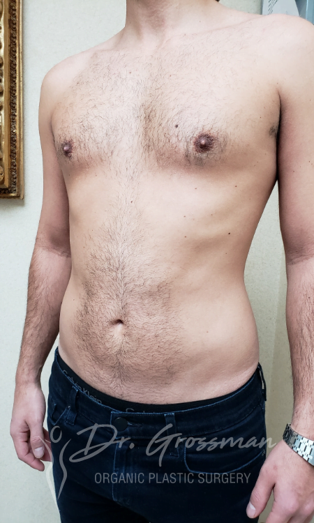 Liposuction 17 Flank Liposuction Male in New York City Plastic Surgery PC