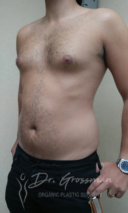 Liposuction 16 Flank Liposuction Male in New York City Plastic Surgery PC