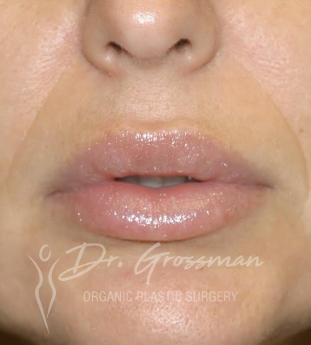 lip augmentation with HA filler 1 1