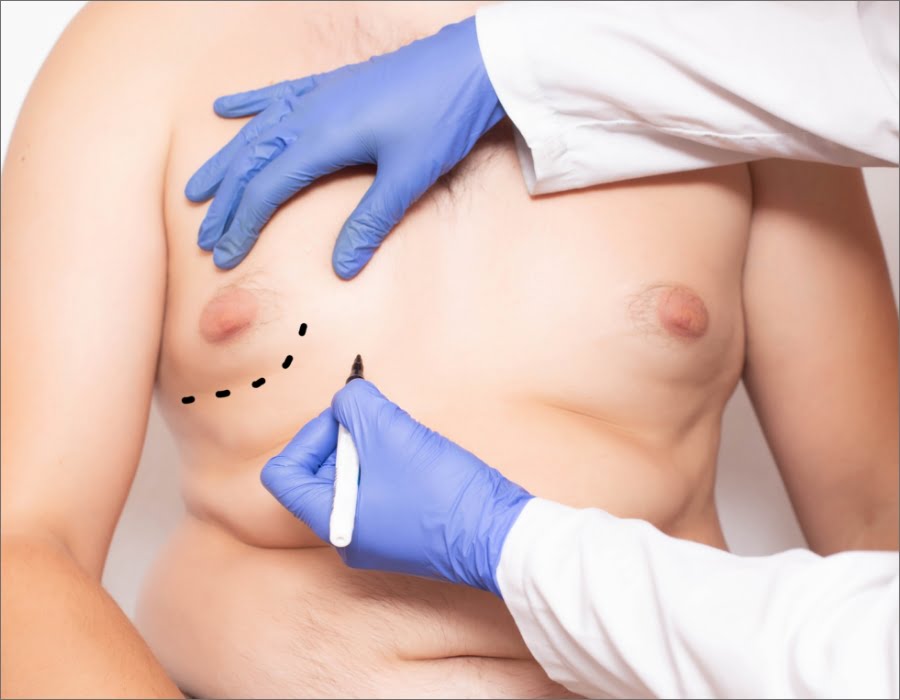 Male Breast Reduction | Dr. Leonard Grossman M.D. | NY