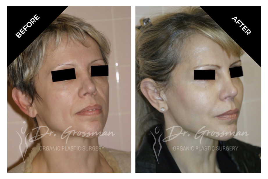 Before and After Face rejuvenation with fat | Dr. Leonard Grossman M.D. | New York
