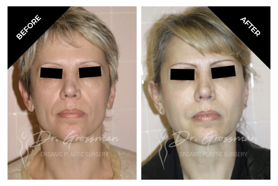 Before and After Face rejuvenation with fat | Dr. Leonard Grossman M.D. | New York