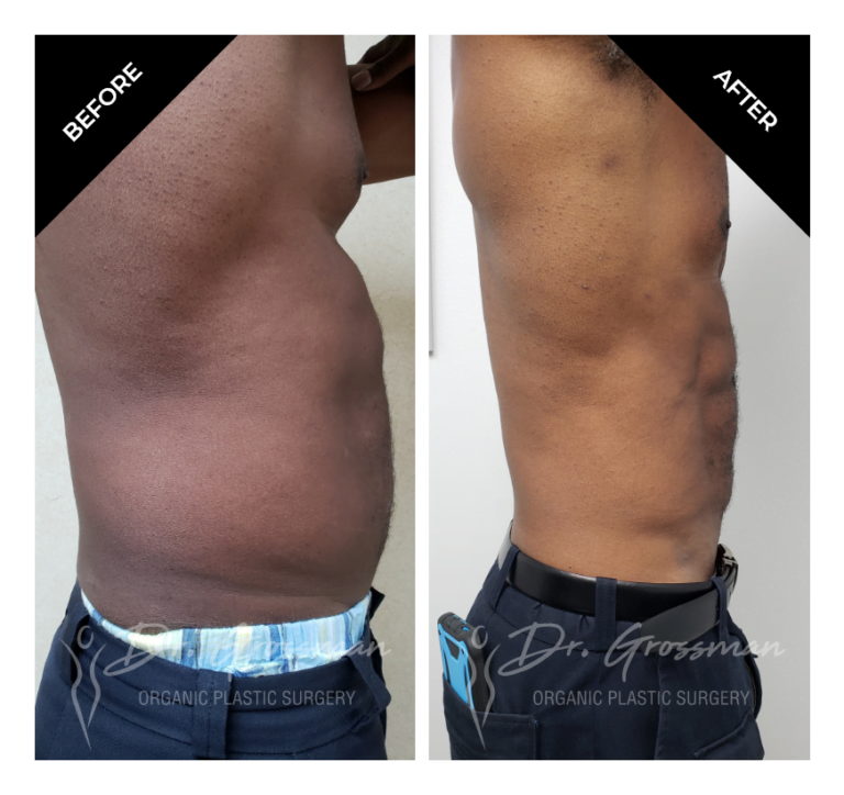 Abdominal Etching Before & After Images In New York