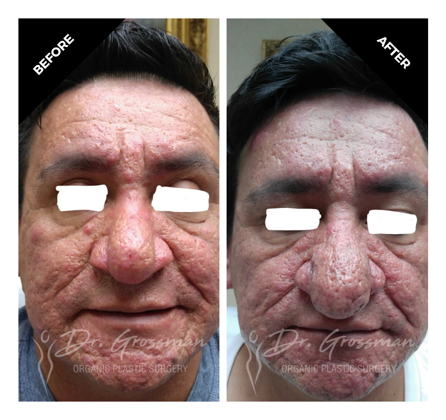 before and after rhinophyma treatment with renuvion