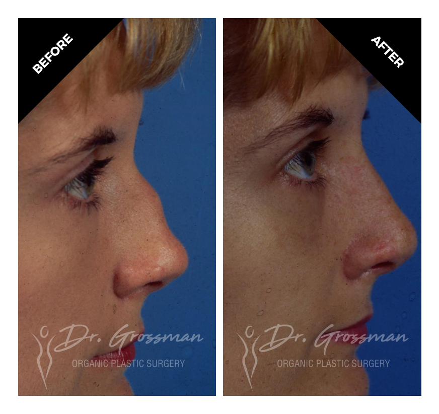 before and after rihnoplasty treatment plastic surgeon emmons ave brooklyn new york ny drgrossman