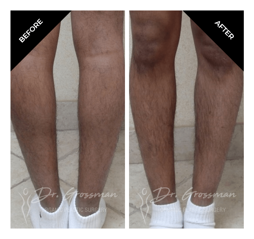 Before and After Bowed leg correction | Dr. Leonard Grossman M.D. | New York