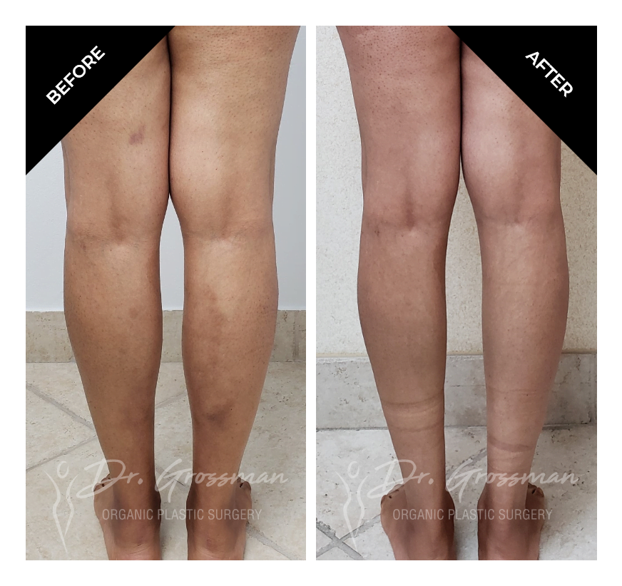 Before and After Bowed leg correction with Fat grafting | Dr. Leonard Grossman M.D. | New York