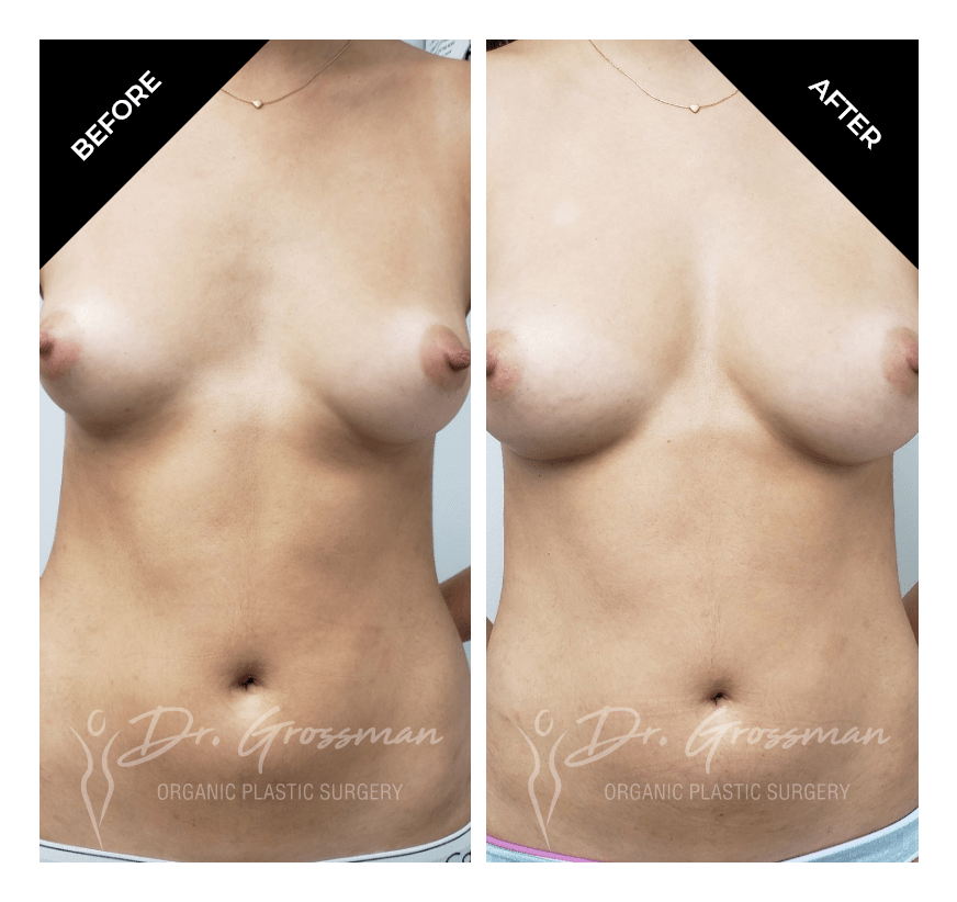 Before and After Breast Aug with Fat | Dr. Leonard Grossman M.D. | New York