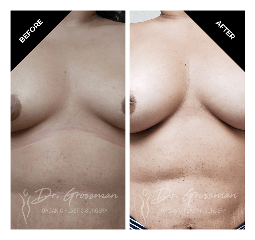 Before and After Breast Aug with fat | Dr. Leonard Grossman M.D. | New York