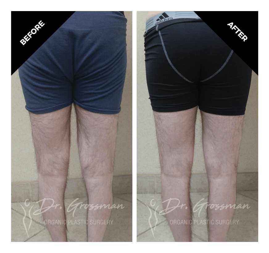 Before and After Calf Augmentation of Legs | Dr. Leonard Grossman M.D. | New York