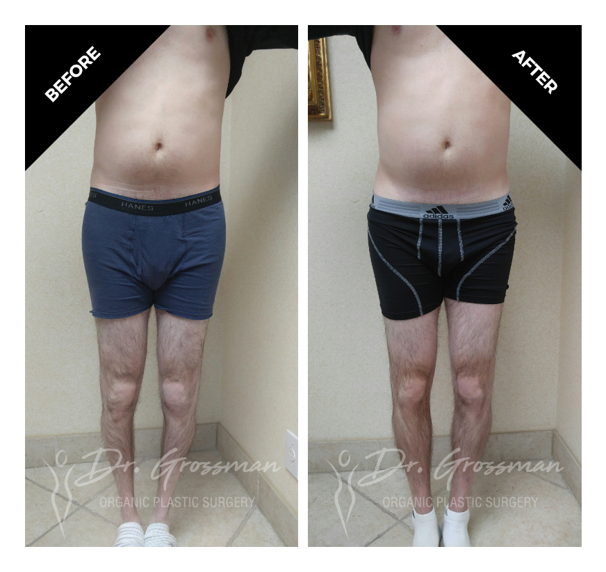 Before and After Calf Augmentation with Fat | Dr. Leonard Grossman M.D. | New York