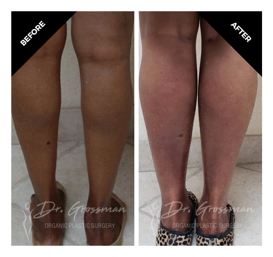 Before and After Calf Augmentation of Legs | Dr. Leonard Grossman M.D. | New York