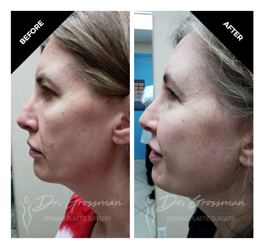 face rejuvenation with fat grafting 1 4