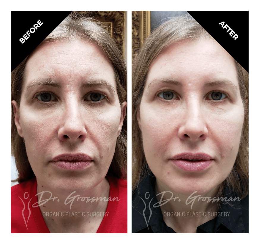 face rejuvenation with fat grafting 1