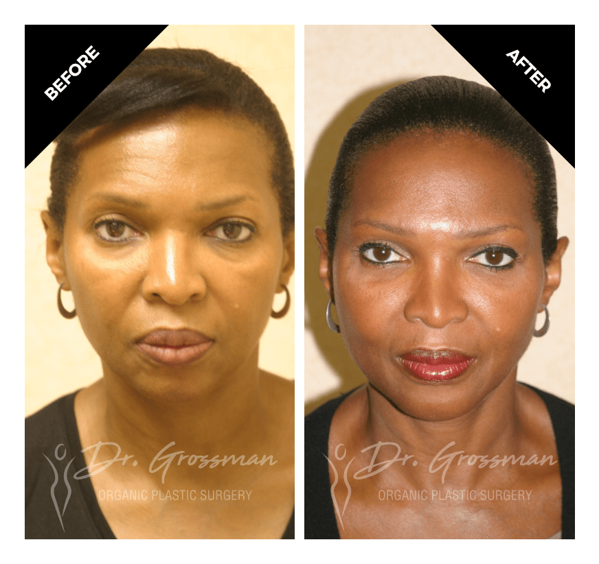 face rejuvenation with fat grafting 3