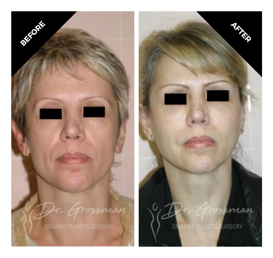 face rejuvenation with fat grafting
