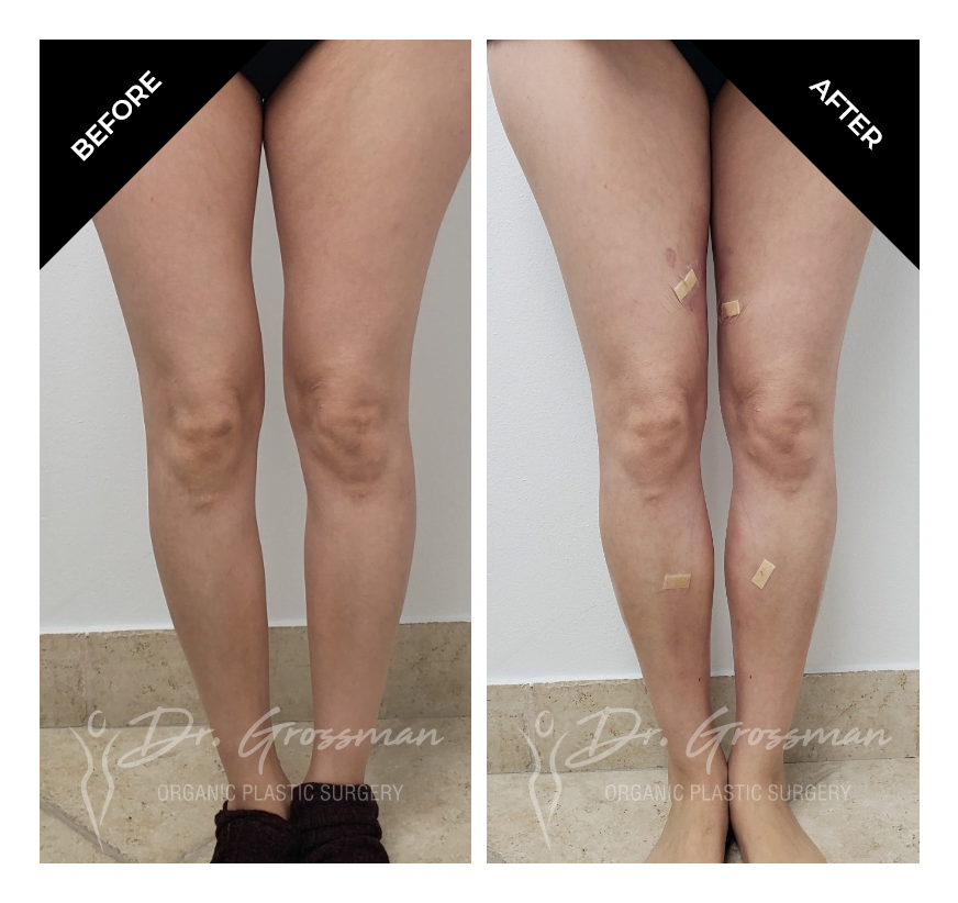 Before and After Fat transfer to calves and inner thighs | Dr. Leonard Grossman M.D. | New York