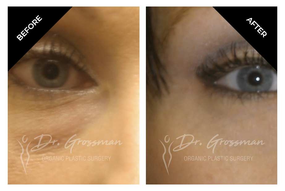 Before and After Fat transfer to lower Eye lid | Dr. Leonard Grossman M.D. | New York