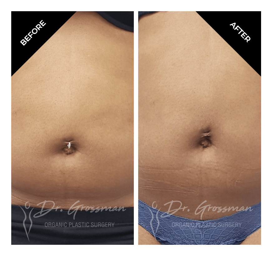 Before and After Waist Liposuction | Dr. Leonard Grossman M.D. | New York