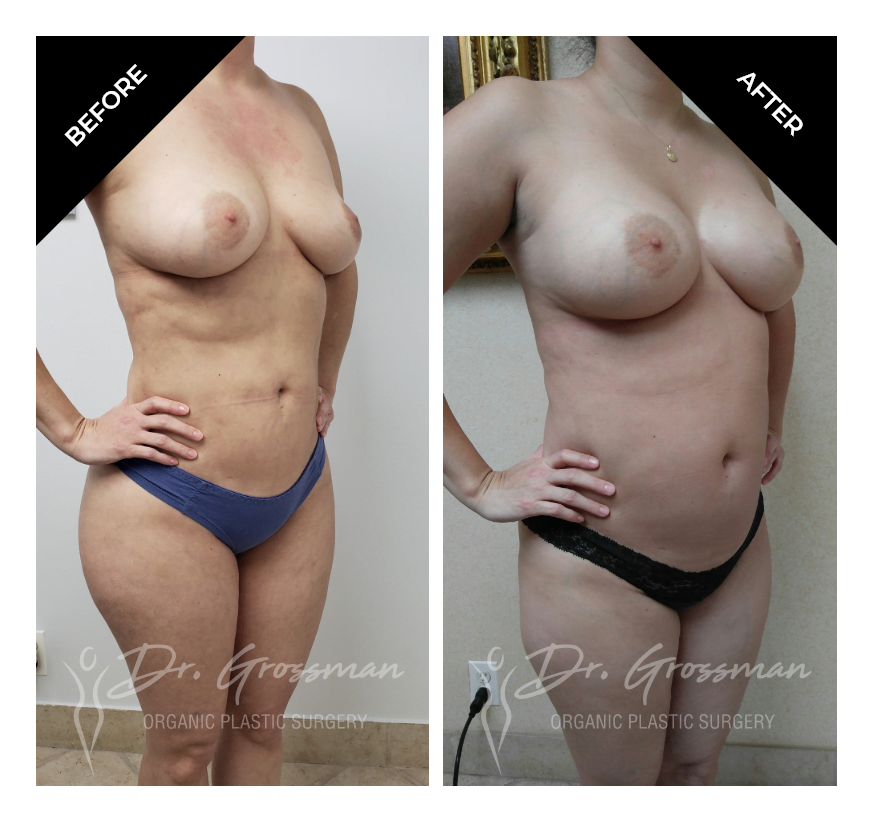 Before and After Lipo Etching and Breast reduction by Liposuction | Dr. Leonard Grossman M.D. | New York
