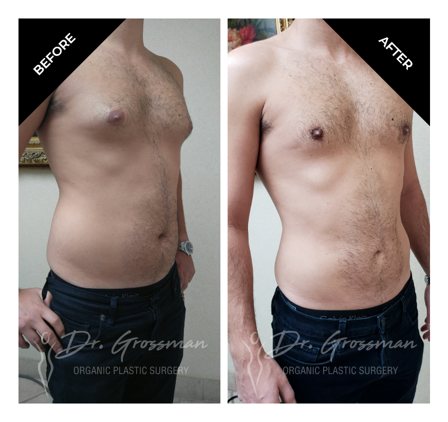 Before and After Flank Liposuction | Dr. Leonard Grossman M.D. | New York