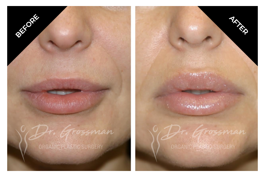 Lip Augmentation with HA Filler | Dr. Leonard Grossman M.D. | New York