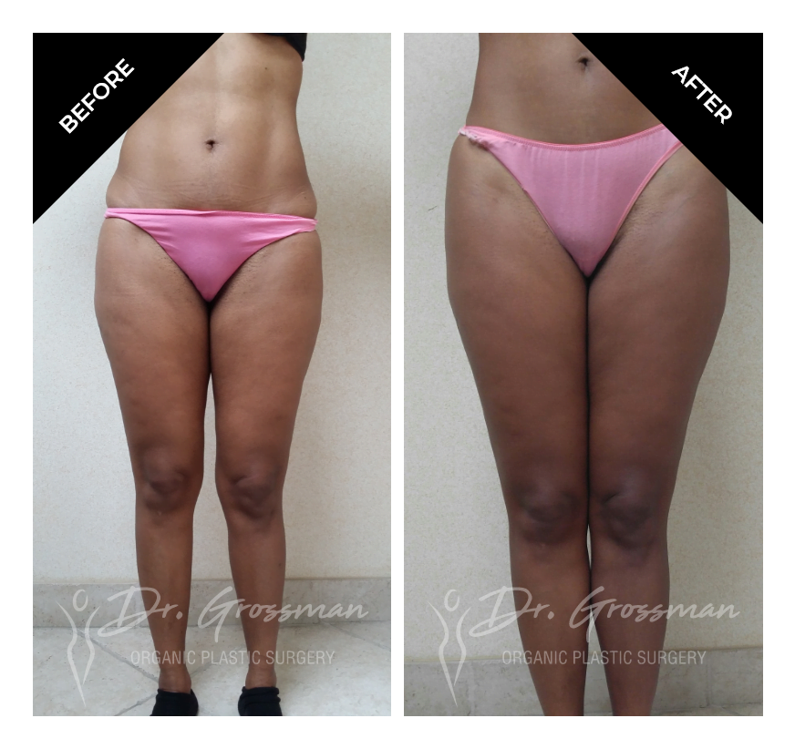 Before and After Liposuction calf augmentation | Dr. Leonard Grossman M.D. | New York