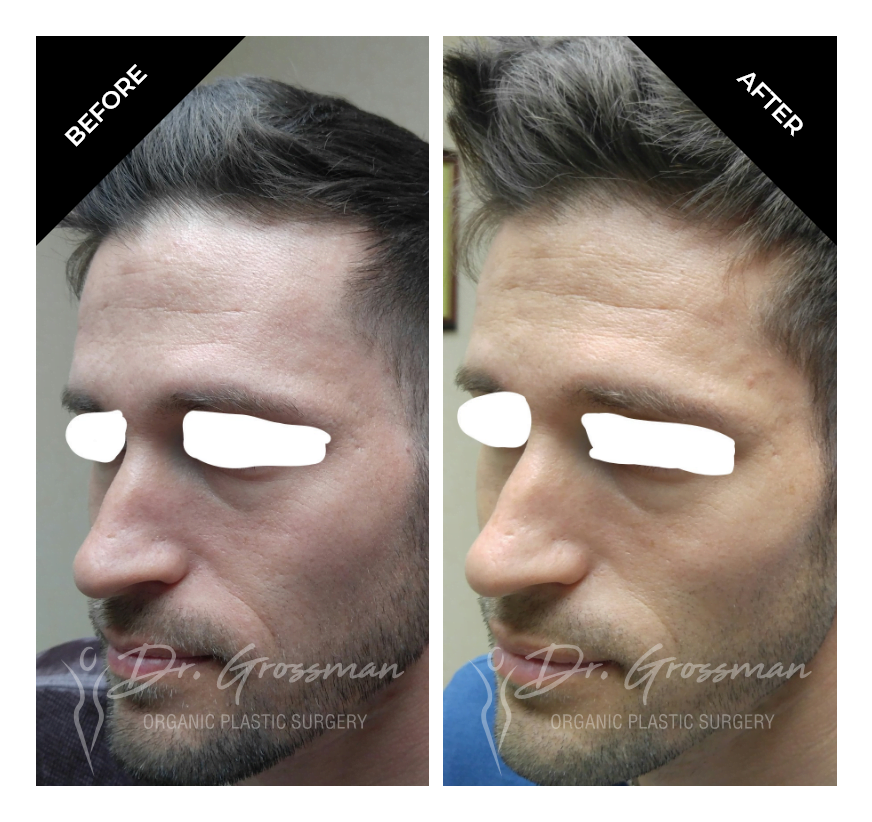 Before and After Otoplasty Ear Reshaping treatment | Dr. Leonard Grossman M.D. | New York