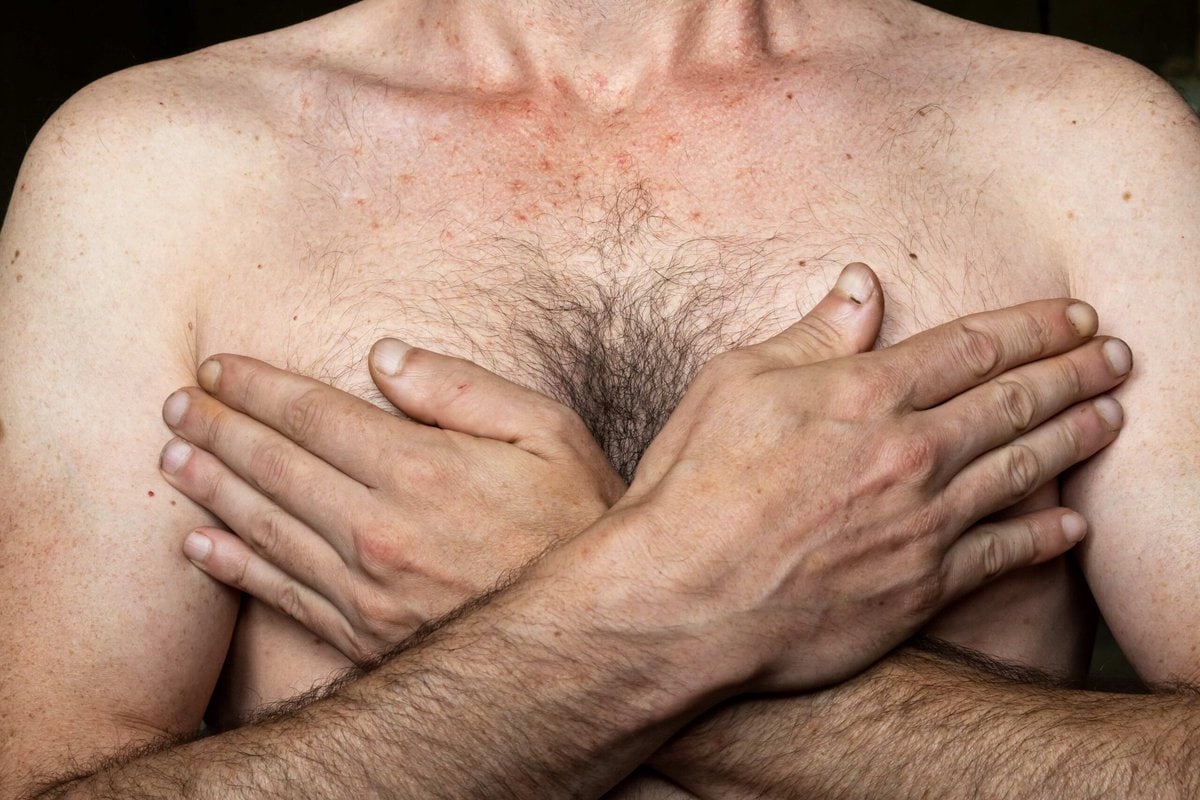 Male Breast Reduction by Dr Grossman in NYC