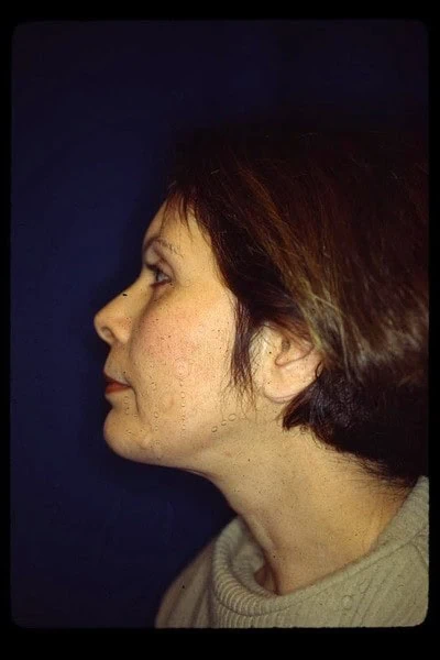 Chin Augmentation After Side Female by Dr Grossman in NY US