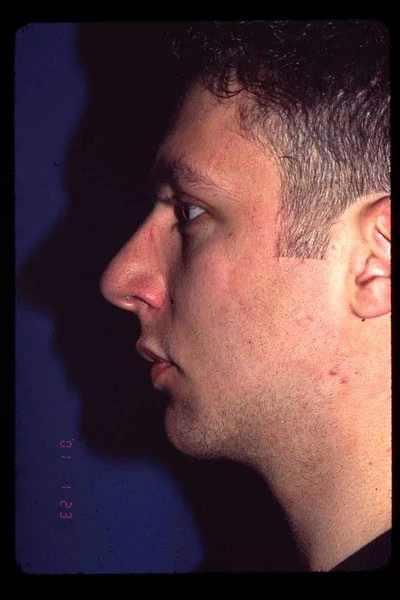 Chin Augmentation After Side Male by Dr Grossman in NY US