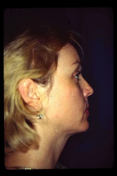 Chin Augmentation After Side Up by Dr Grossman in NY US