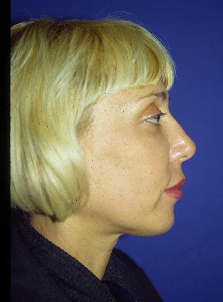 Chin Augmentation After Side by Dr Grossman in NY US