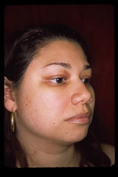 Chin Augmentation Before Front by Dr Grossman in NY US