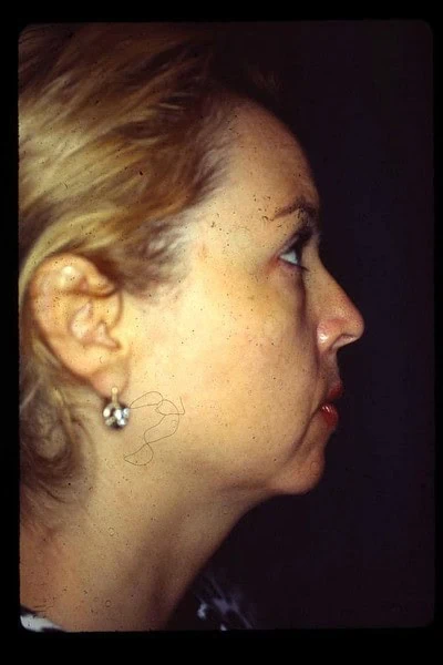 Chin Augmentation Before Side Up by Dr Grossman in NY US